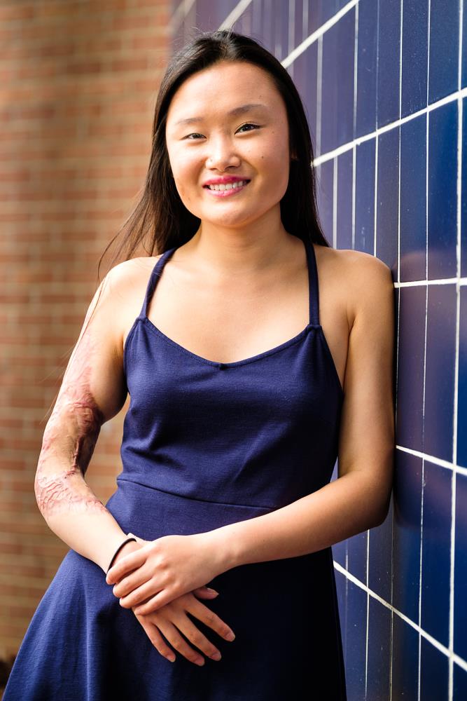 Elise showing the burn scars on her arm 